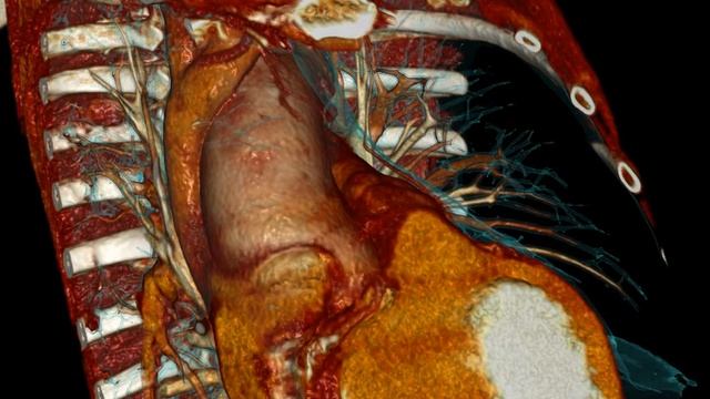 Aneurysm of the aorta Pronounced aortic atherosclerosis Lymph nodes mediastinum 3D reconstructio смотреть онлайн