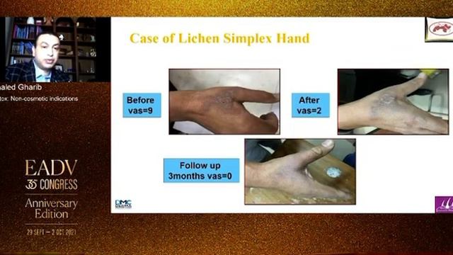 Botox Non Cosmetic Indications смотреть онлайн