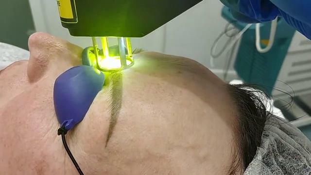 Лазерная шлифовка смотреть онлайн