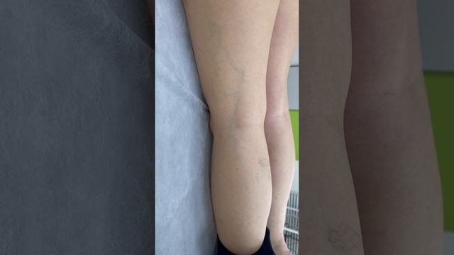 Сосудистая сетка. Склеротерапия. Флеболог Москва. Флеболог смотреть онлайн