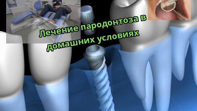 Лечение пародонтоза в домашних условиях смотреть онлайн