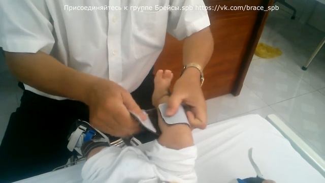 Брейсы АДМ по-вьетнамски (косолапость) смотреть онлайн