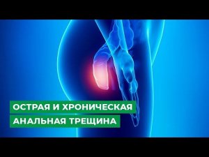 Острая и хроническая анальная трещина. Лечение или операция?