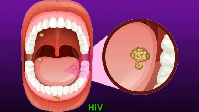 Swollen Cervical Lymph Nodes: Causes And Treatment смотреть онлайн
