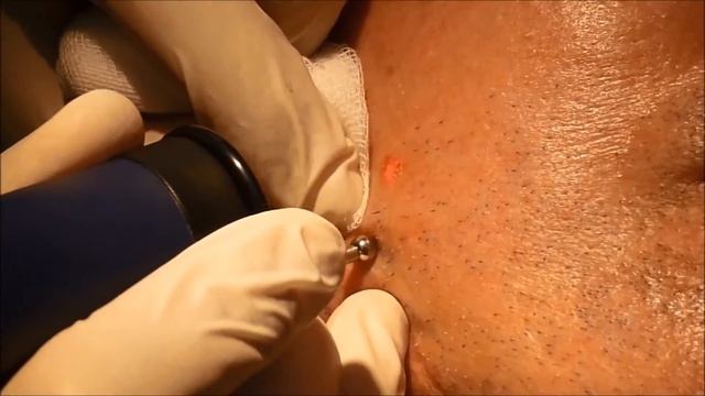 MCL31 Dermablate   Laser Therapy In Dermatology