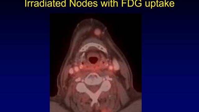 Surveillance Imaging for Head and Neck Cancer: The Rise of NIRADS смотреть онлайн