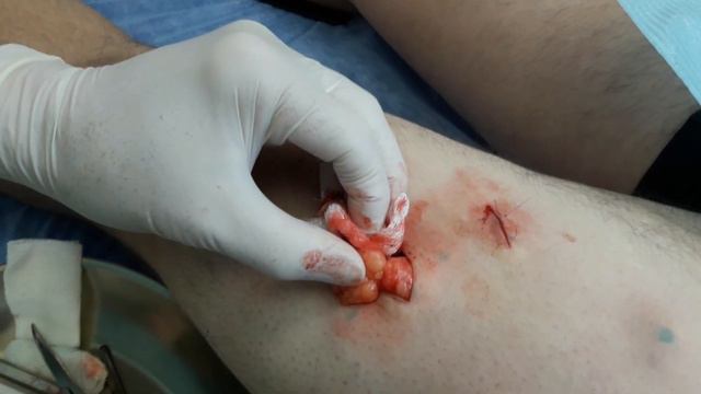 Удаление нескольких липом из одного разреза при липоматозе смотреть онлайн