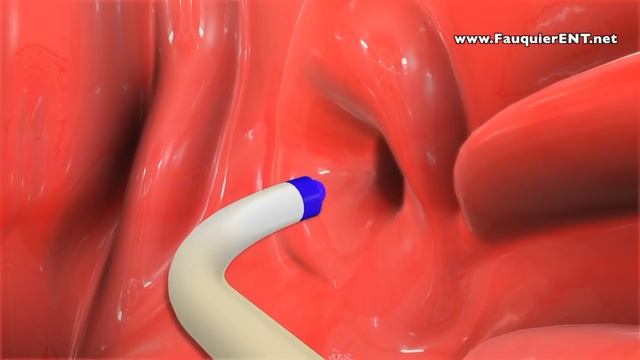Balloon Eustachian Tube Dilation to Treat Eustachian Tube Dysfunction смотреть онлайн
