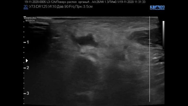 лимфаденит 2