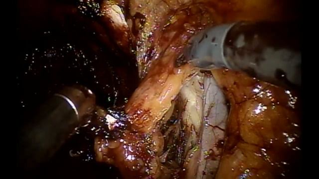 Robotic Lymph Node Dissection for Prostate Cancer смотреть онлайн