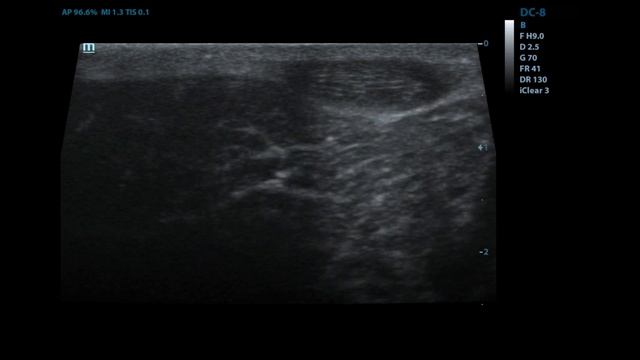 Подкожные гельминты у собаки(дирофилярии) смотреть онлайн