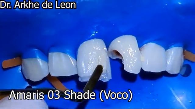 Making the Patient Smile Confidently Again.. Big Caries/cavity in his front teeth.. смотреть онлайн