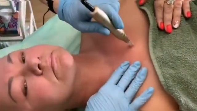 МИКРОНИДЛИНГ. ВСЯ ПРАВДА о процедуре. смотреть онлайн