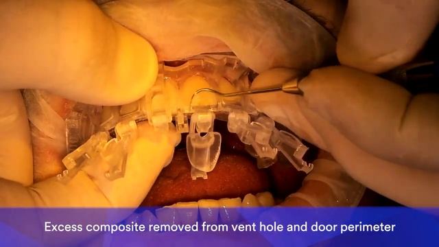 Dr Hodges 6-unit Veneer Case in 2 mins using Filtek Matrix by 3M Oral Care. смотреть онлайн