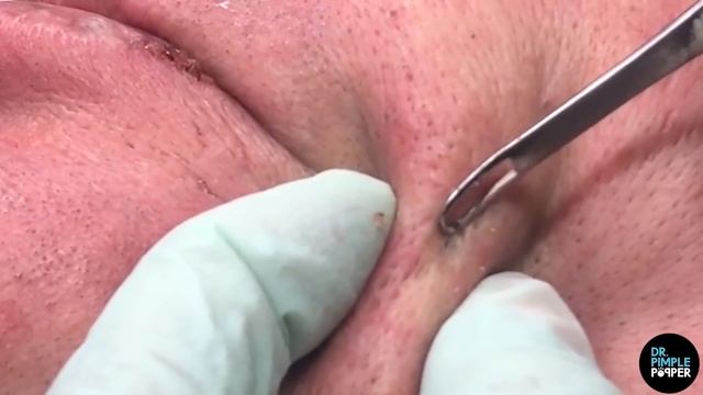 Best Of Blackheads And Dilated Pores Of Winer For 2019