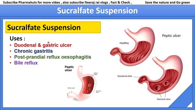 Sucralfate suspension | best medicine for Peptic ulcer | sucral syrup kis kaam mein aata hai | Gas смотреть онлайн
