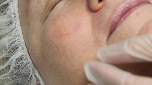 Удаление сосудов на лице