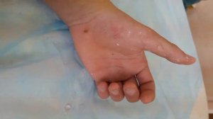 Повреждение сухожилия глубокого разгибателя первого пальца кисти