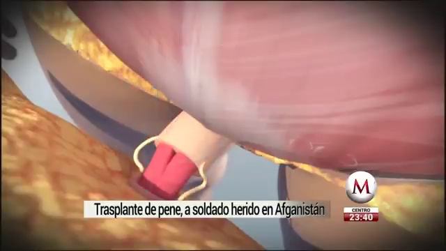 Realizan el primer trasplante de pene y escroto, en EU смотреть онлайн