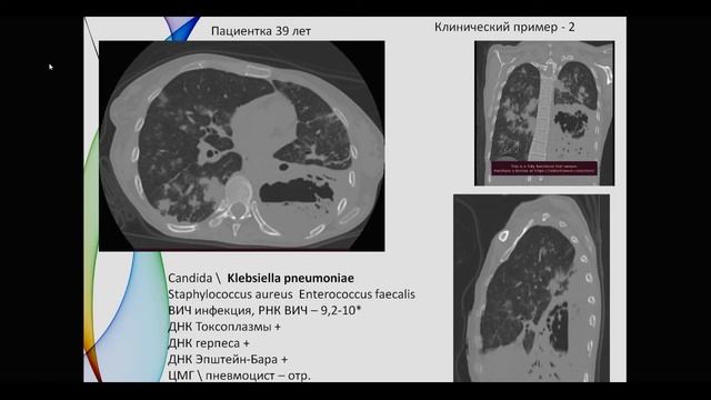 Деструкции легкого после коронавирусной пневмонии - опыт, динамика, теория формирования полостей. смотреть онлайн