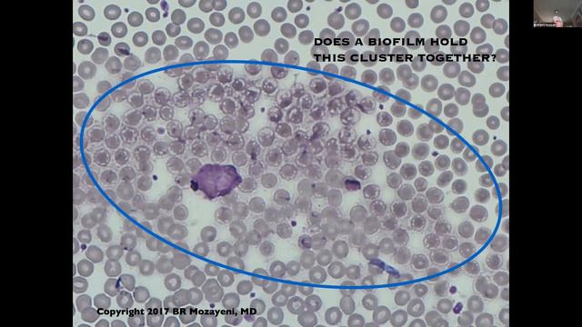 Clinical Spectrum Of Persistent Bartonella Infection And Considerations In Diagnosis And Treatment