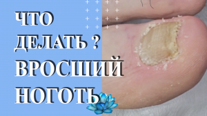Вросший ноготь на ноге. Что делать ?