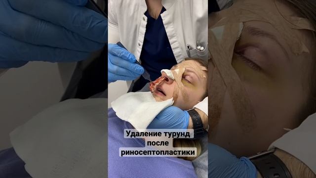 Удаление марлевых турунд после риносептопластики #пластическийхирург#ринопластика смотреть онлайн