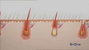 Принцип работы фотоэпилятора E-One