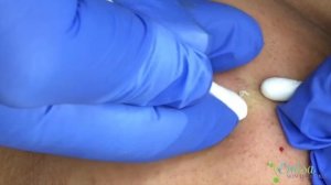 Black Head Extractions