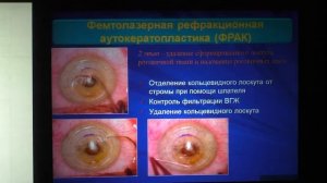 Фемтолазерная рефракционная аутокератопластика - новый способ хирургического лечения кератоконуса