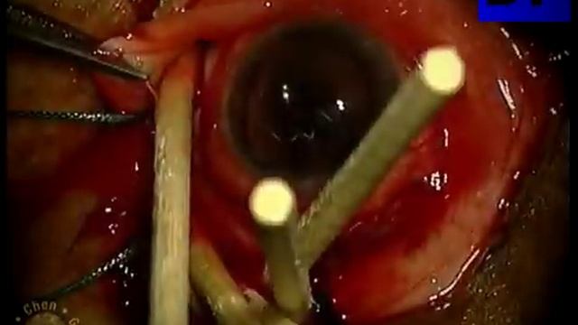 Хирургия глаукомы  (Glaucoma Surgery) - 8
