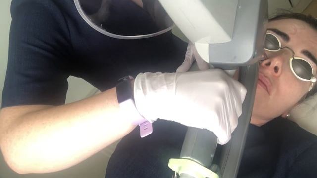 How to remove freckles , Sun spots fast with Pearl laser resurfacing смотреть онлайн