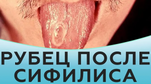 Рубец после сифилиса
