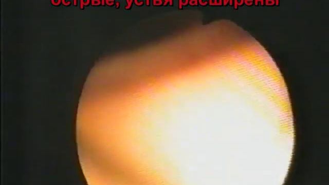Мокрота с угольной пылью. Атрофический бронхит. смотреть онлайн