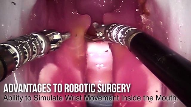 Robots in the Operating Room: The Future of Cleft Palate Repair смотреть онлайн