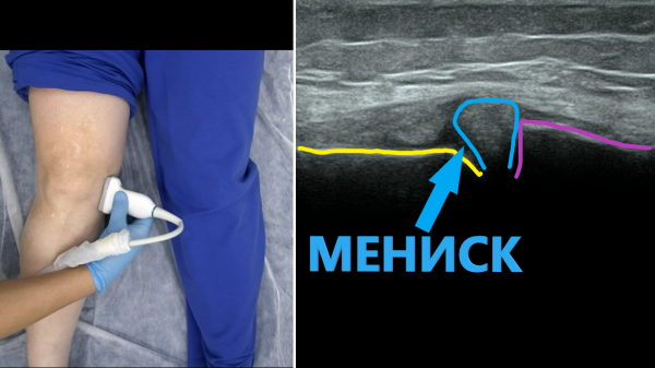 УЗИ коленного сустава
