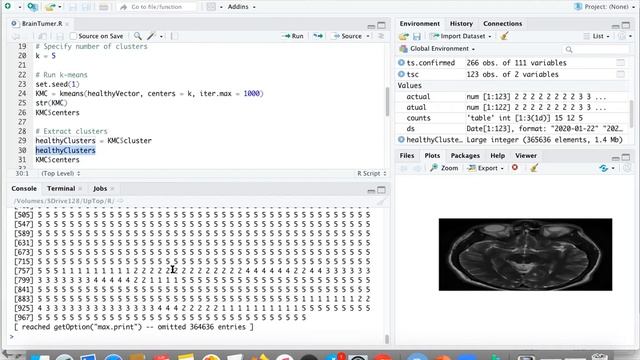 K Means Clustering Algorithm | K Means Brain Tumor Example in R | Machine Learning Algorithms смотреть онлайн