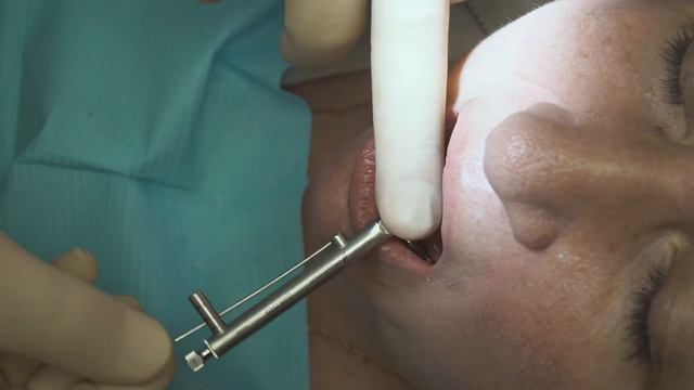 Протезирование на имплантатах с использованием балочной конструкции смотреть онлайн