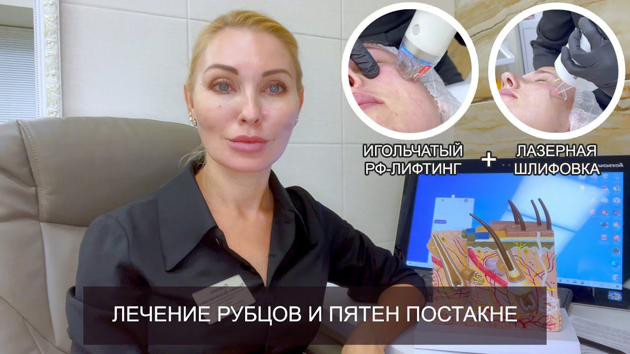 Лечение #постакне смотреть онлайн