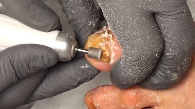 Ногти пожилого человека??? • Зачистка???