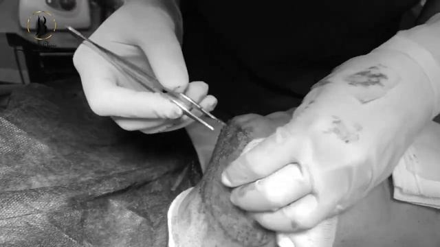 Пересадка волос, полный процесс пересадки волос смотреть онлайн