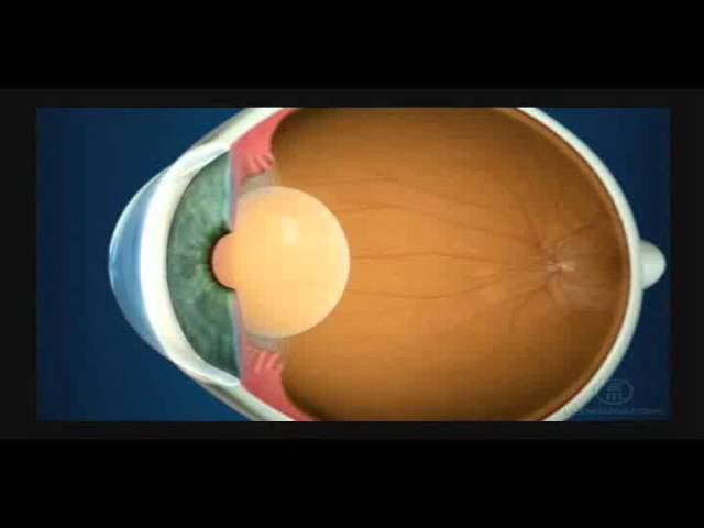 Катаракта смотреть онлайн