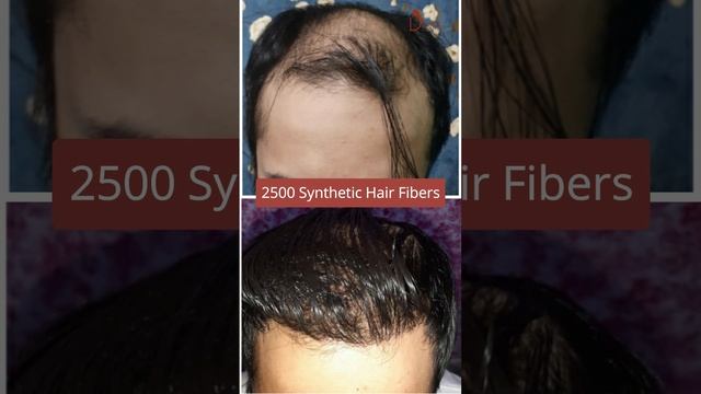 Don't you have a good donor Area? Still, Searching for Hair Transplant Surgery? смотреть онлайн