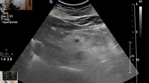 УЗИ желчного пузыря. Дилатация холедоха.