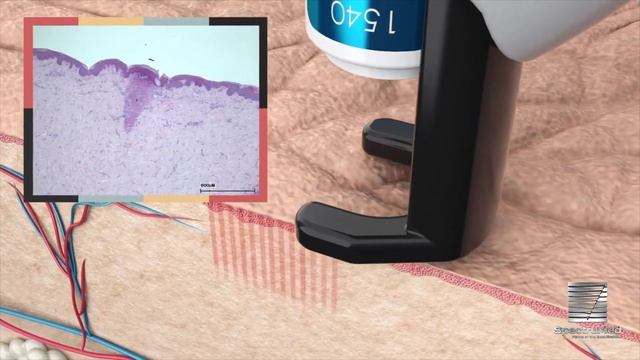 Harmony XL Pro Featuring ClearSkin By Alma Lasers