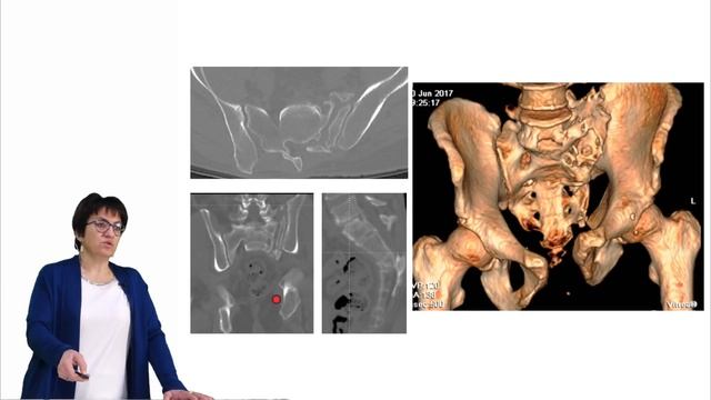 Застарелые повреждения тазового кольца смотреть онлайн