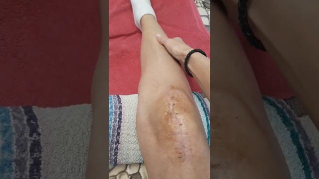 Перелом надколенника со смещением. смотреть онлайн