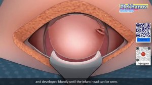 Первичное кесарево сечение