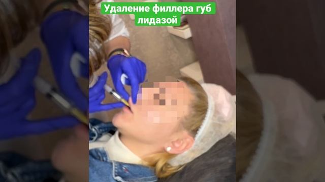 Выведение филлера губ лидазой #косметолог #косметологмосква #косметология #контурнаяпластика #филле смотреть онлайн