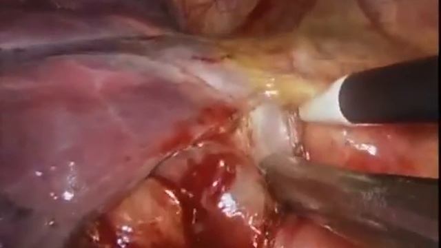 Right Side Systemic Mediastinal Lymph Node Dissection смотреть онлайн